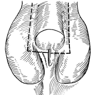 360°全面解析：阴茎矫正