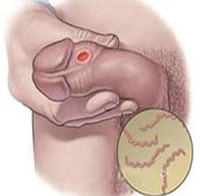 360°全面解析：龟头炎