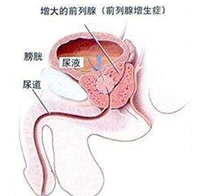 360°全面解析：前列腺增生