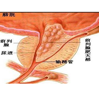 360°全面解析：前列腺肥大